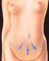 Ou se situe la cicatrice d'une abdominoplastie?