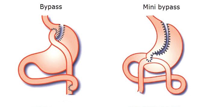 Chirurgie obésité Tunisie : quelle technique vous correspond ?